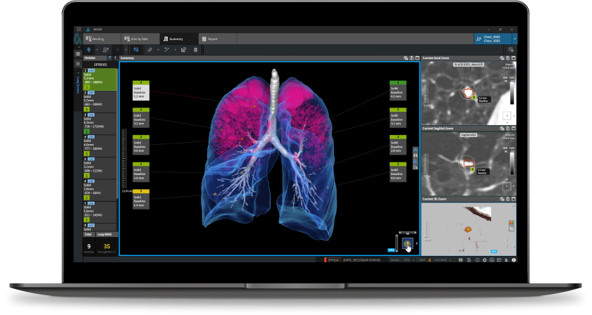 aview LCS | Lung Cancer Screening AI Solution