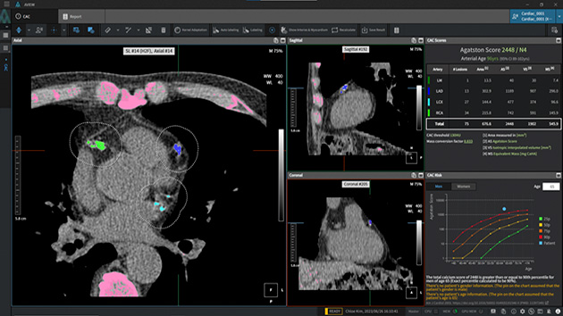 Coreline Soft win FDA 510(k) clearance for AI-powered coronary artery calcification analysis solution