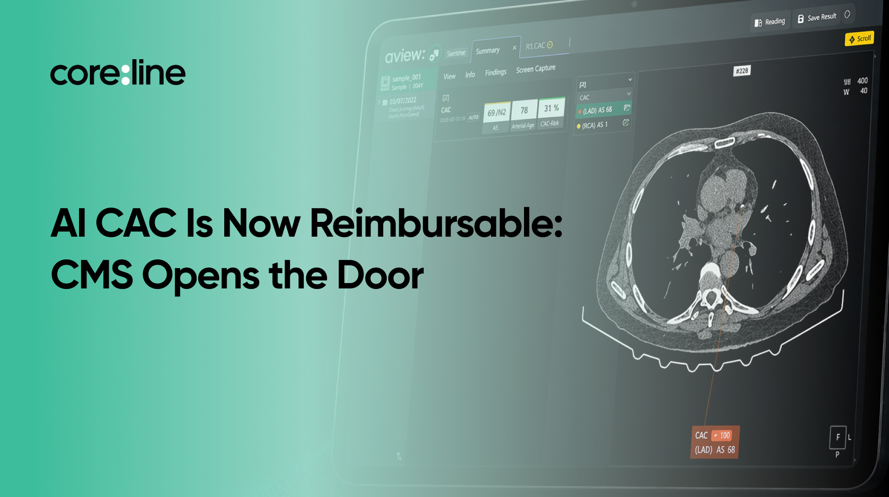 CMS Just Created a Reimbursement Code for AI-Based CAC Analysis. Here's What It Means for Your Practice.