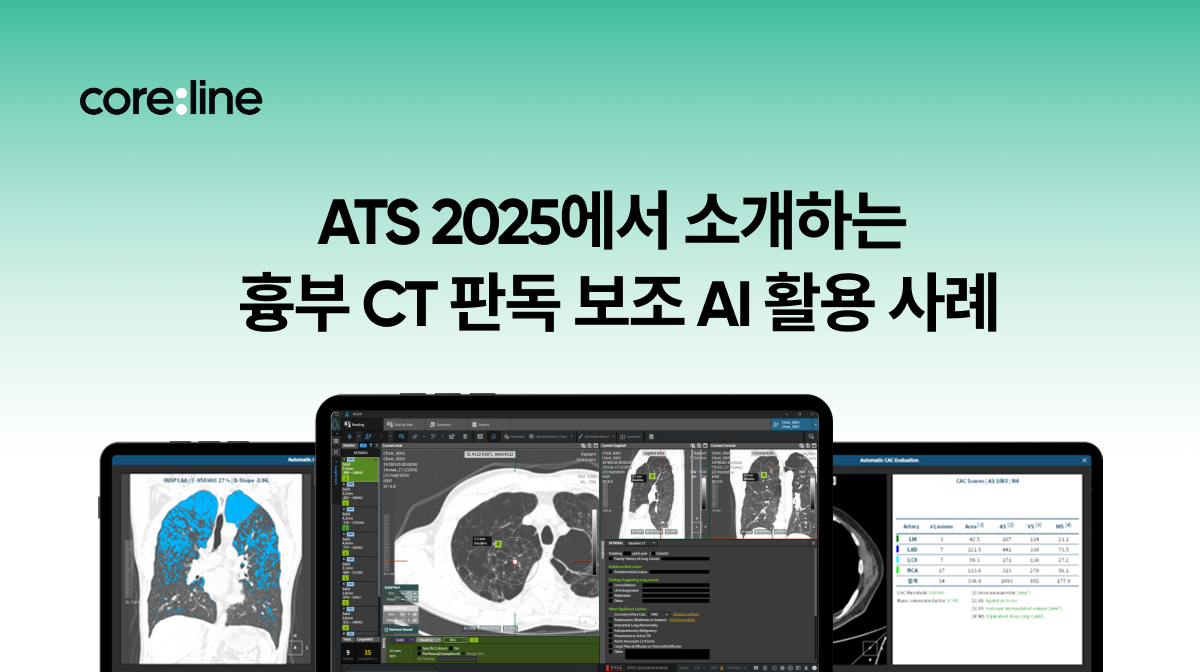 코어라인소프트, ATS 2025에서 소개하는 흉부 CT 판독 보조 AI 활용 사례